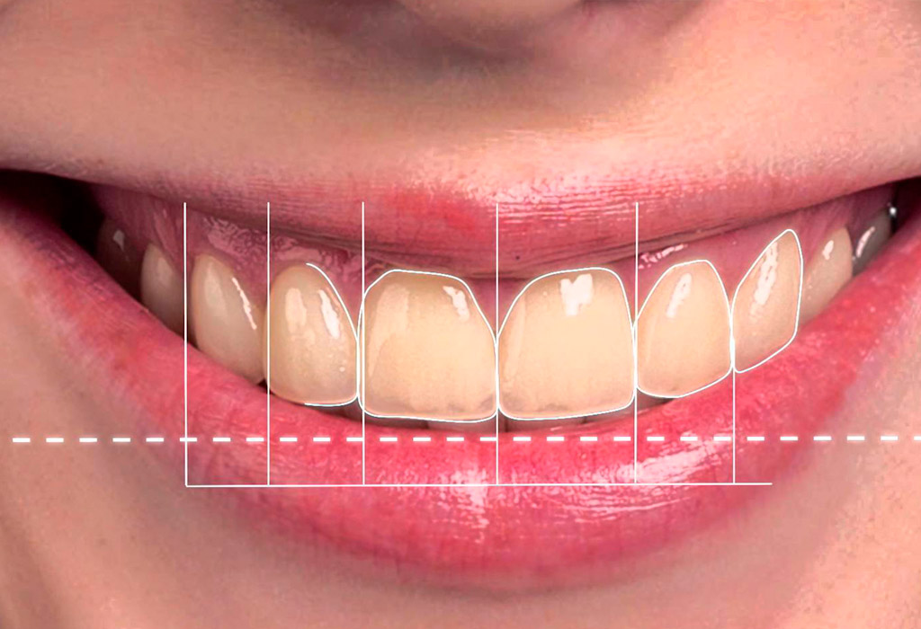 ᐈ Carillas Dentales en Santiago - Clínica Dental OnSmile